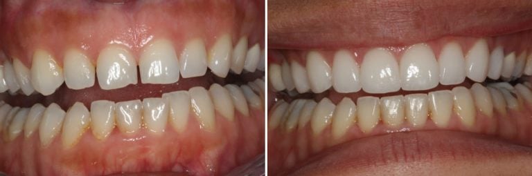 Dr. Bob Perkins DDS, Before and After Photo Gallery