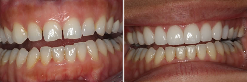 before and after dental procedure