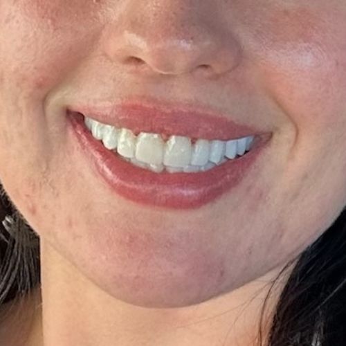 AFTER Photo - face is balanced with a beautiful natural smile