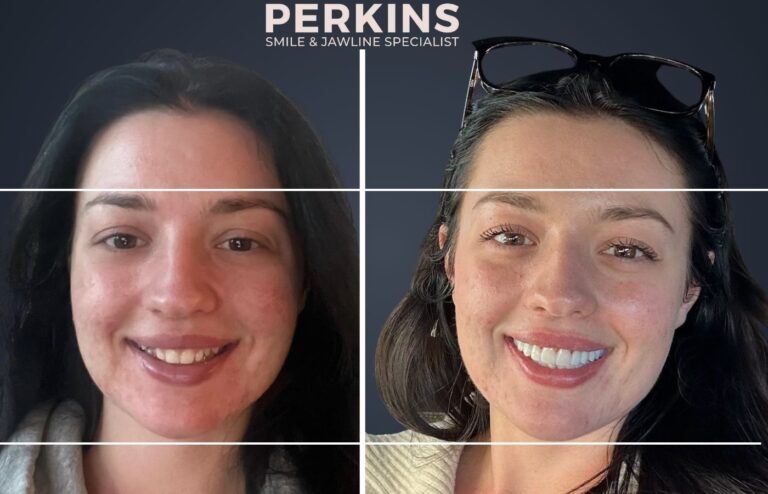 JawAlign™ & Prepless Veneers Before & After