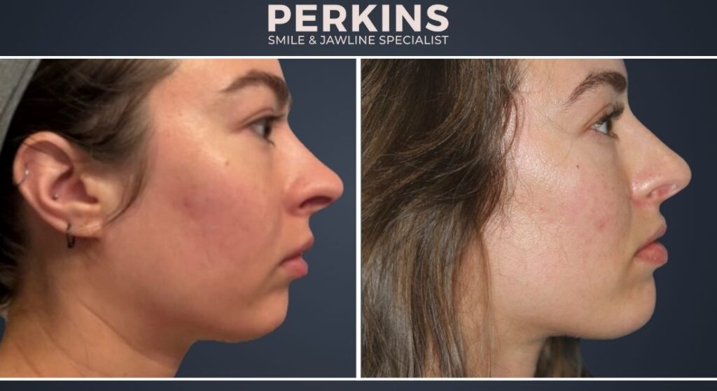 Class 2 Overbite Correction Jaw Surgery Alternative