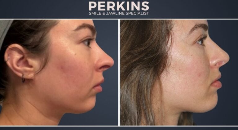 Class 2 Overbite Correction Jaw Surgery Alternative