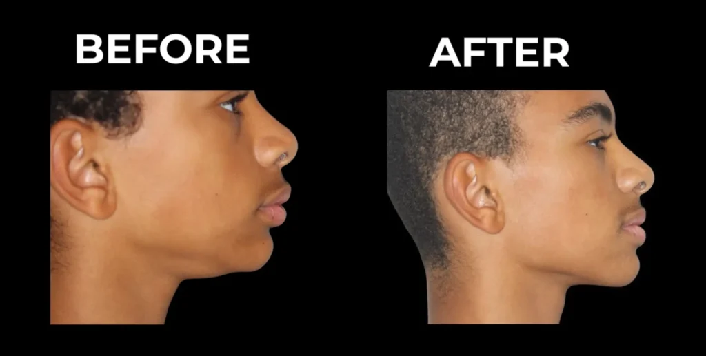 Overbite Correction Before and After