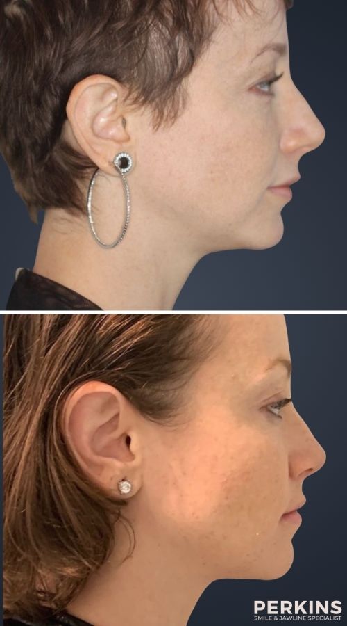 Deep Overbite Correction Without Surgery