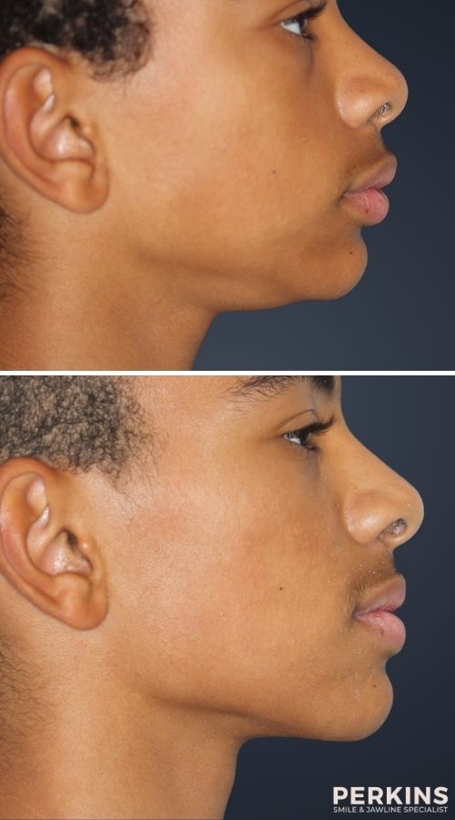 Class II Malocclusion Correction Without Surgery
