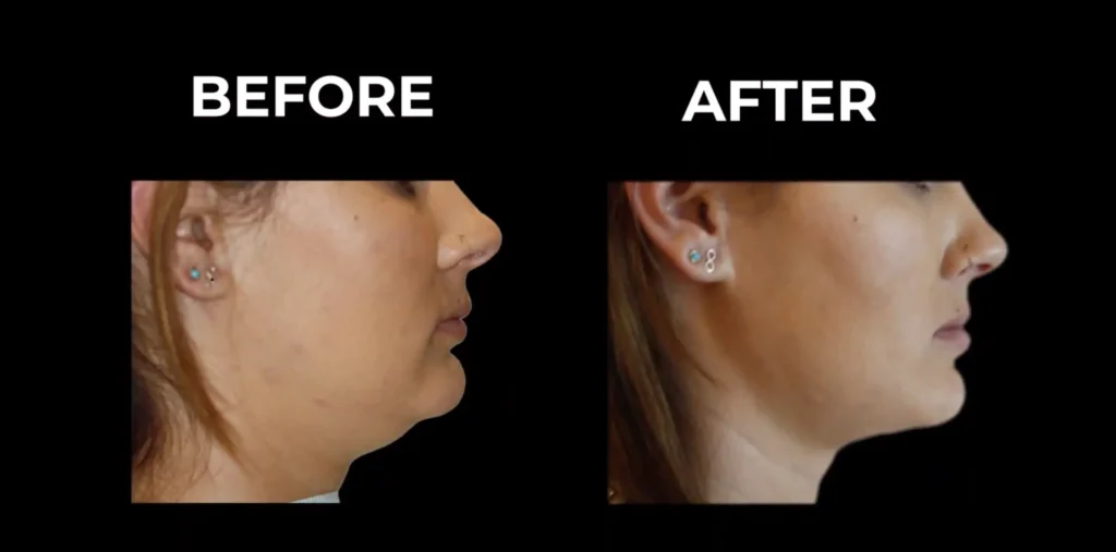 Double Chin Before and After